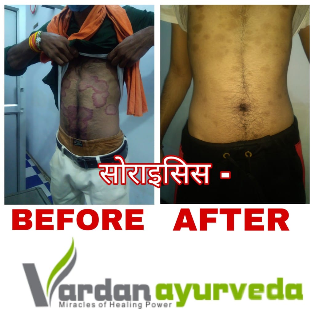 सोराइसिस से पा सकते हैं मुक्ति जाने कैसे