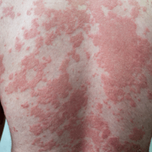 Psoriasis Treatment in Lucknow