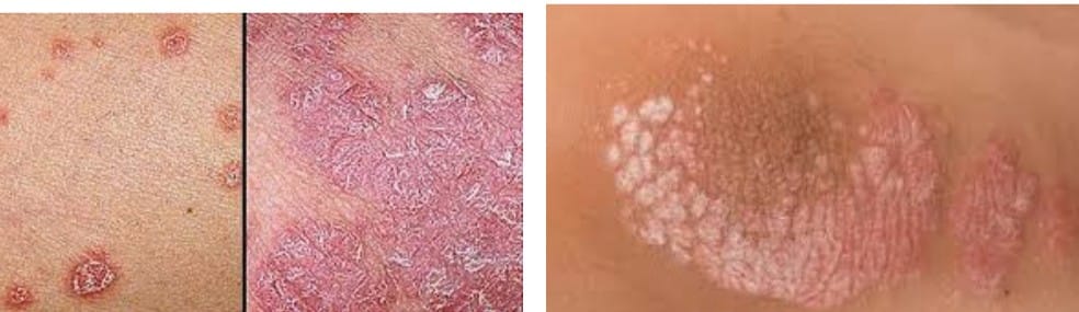 psoriasis-treatment