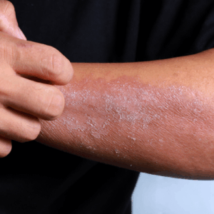 Skin Disease Treatment in Lucknow