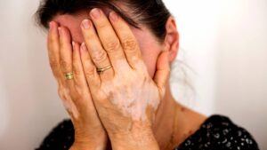 Safed Daag Treatment in Lucknow